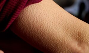 Weird Facts About the Human Body, goosbumps